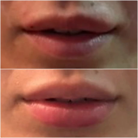 Juvederm Volbella Before and after Available at Dr Azoo Clinic, Ealing, London