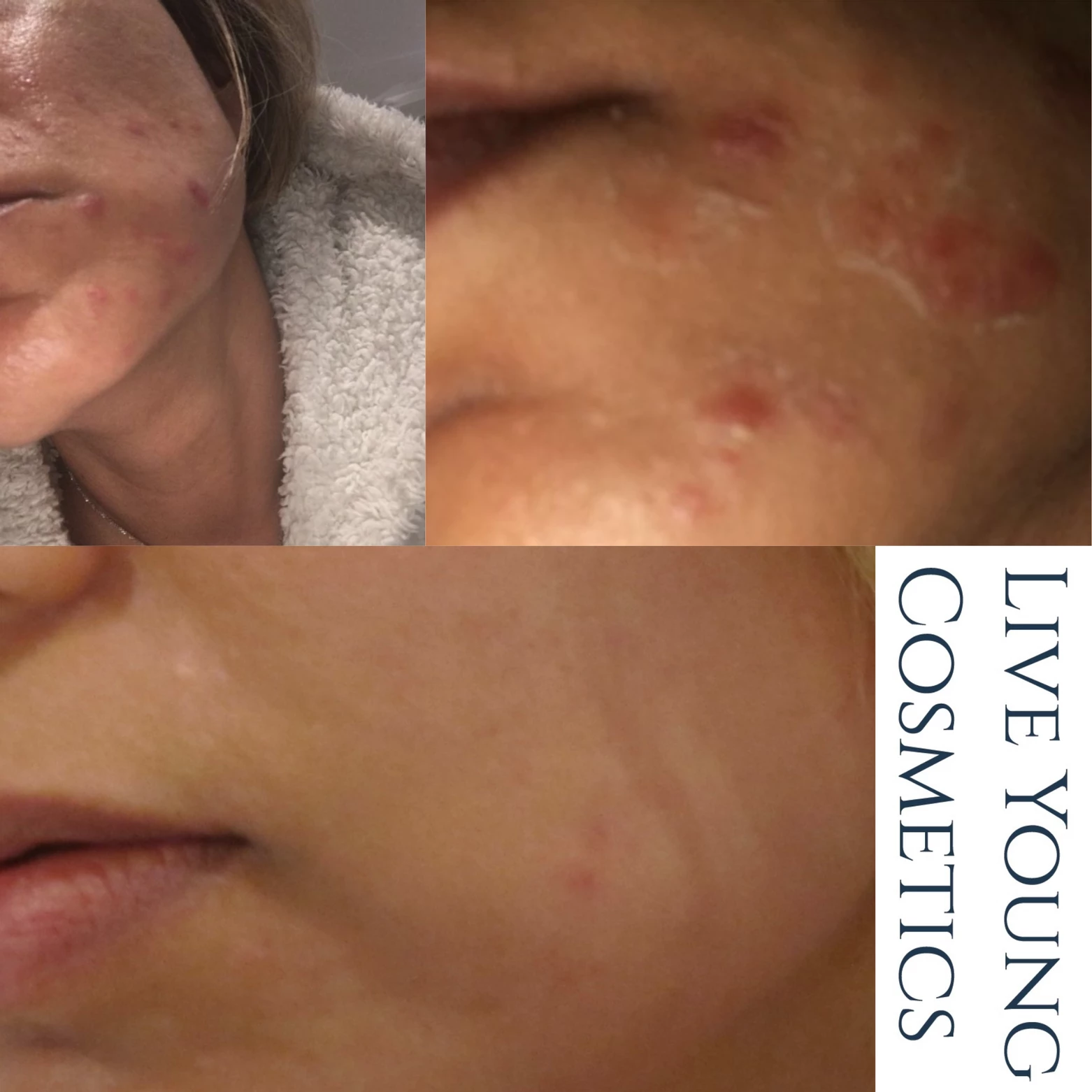 Acne treatment with microneedling, ZO skin care and topical Tretinoin Available at Dr Azoo Clinic, Ealing, London