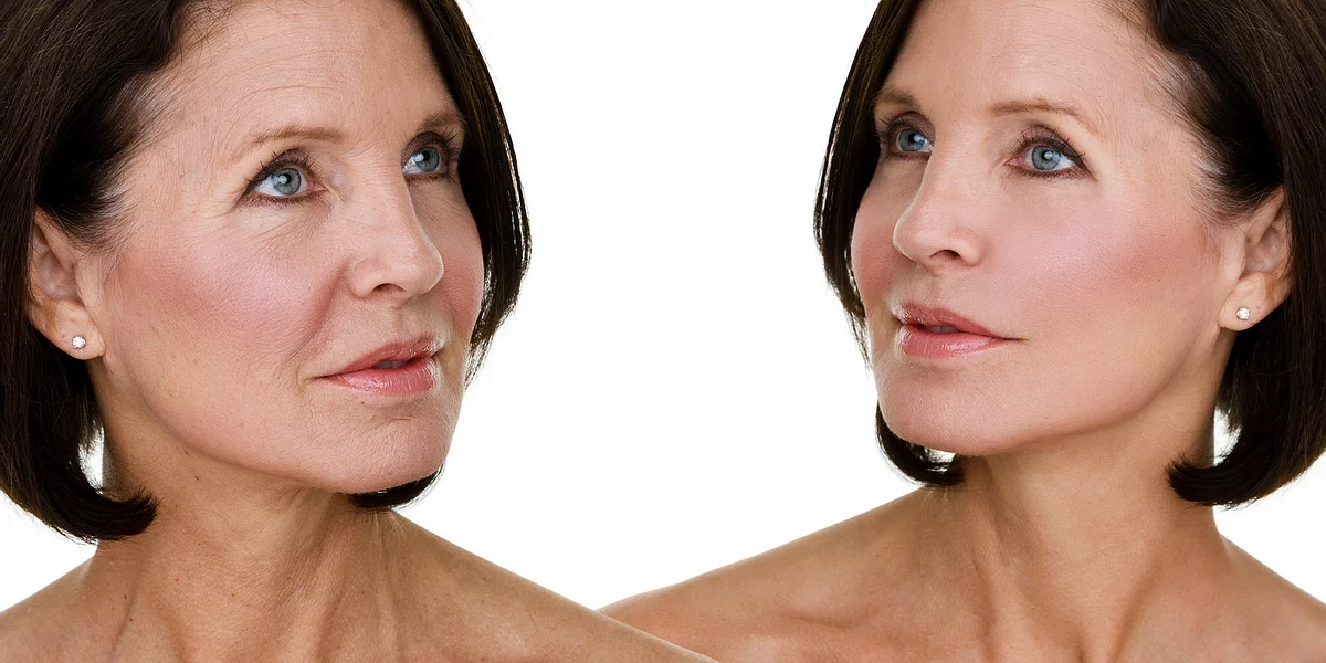 Juvederm Vycross Available at Dr Azoo Clinic, Ealing, London