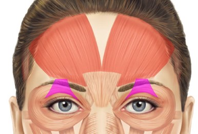 Diagram of the levator muscle that lifts the upper eyelid