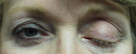 A patient with true upper eyelid ptosis