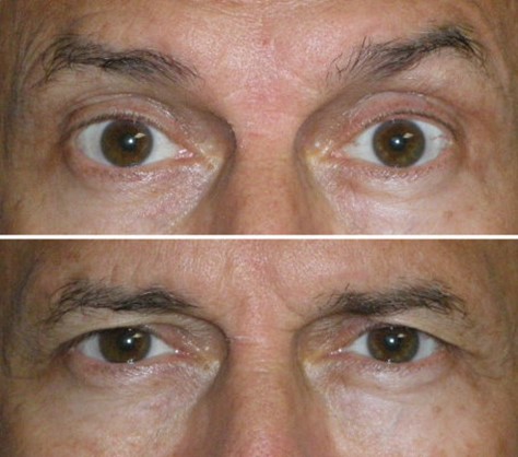 Effect of brow elevation on upper eyelid skin, raised versus relaxed