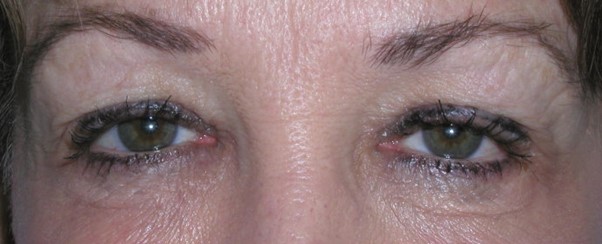 Patient with excess upper eyelid skin who compensates by raising the brows