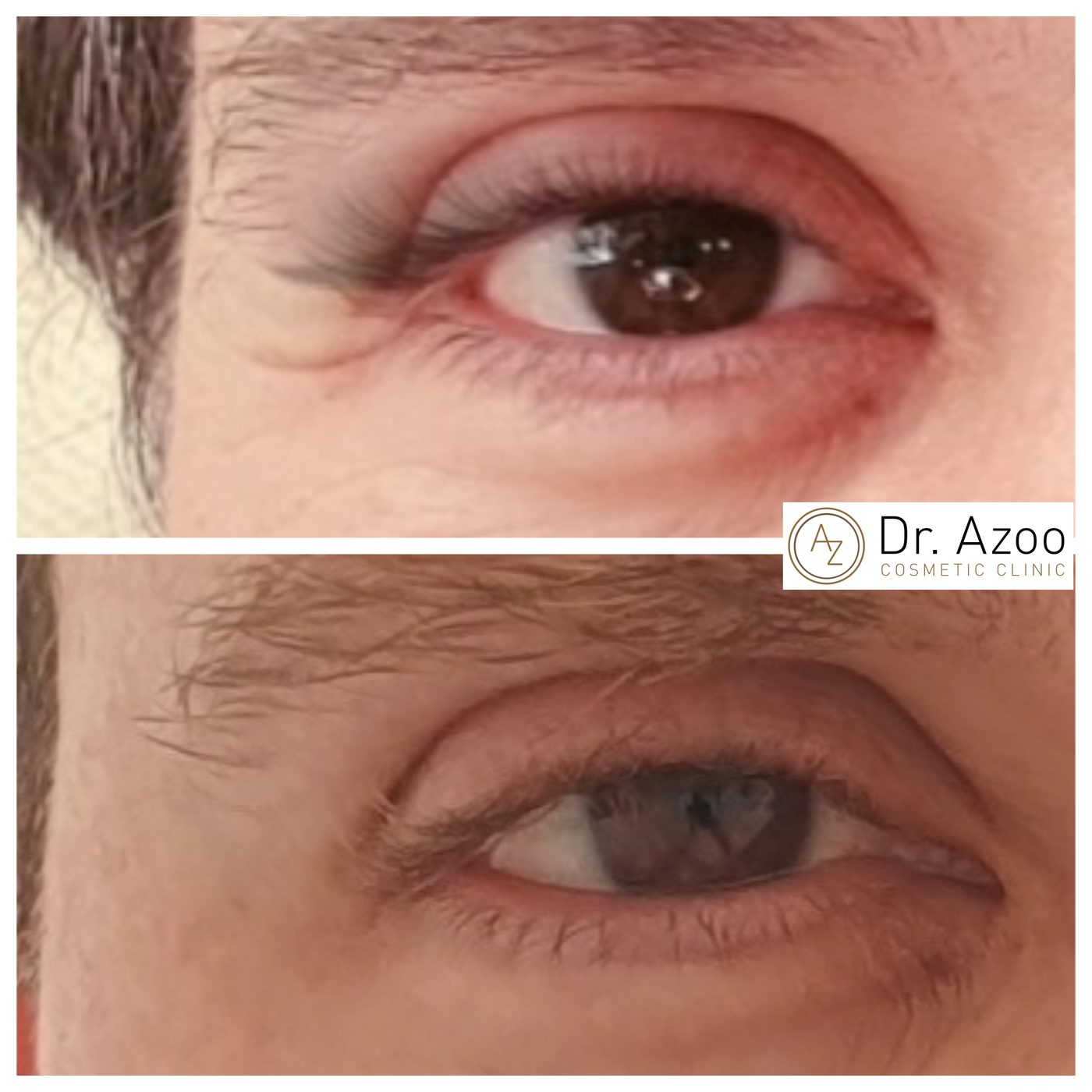 Crow’s feet, before and after. Anti-wrinkle injections